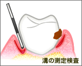 歯槽膿漏　溝の測定検査