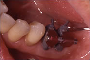 歯周外科手術時